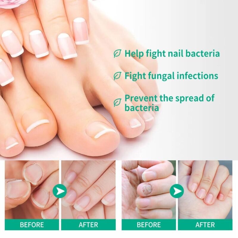 Nail Care, Nail Treatment, Metanail Toenail Treatment Serum