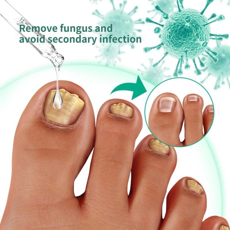 Nail Care, Nail Treatment, Metanail Toenail Treatment Serum