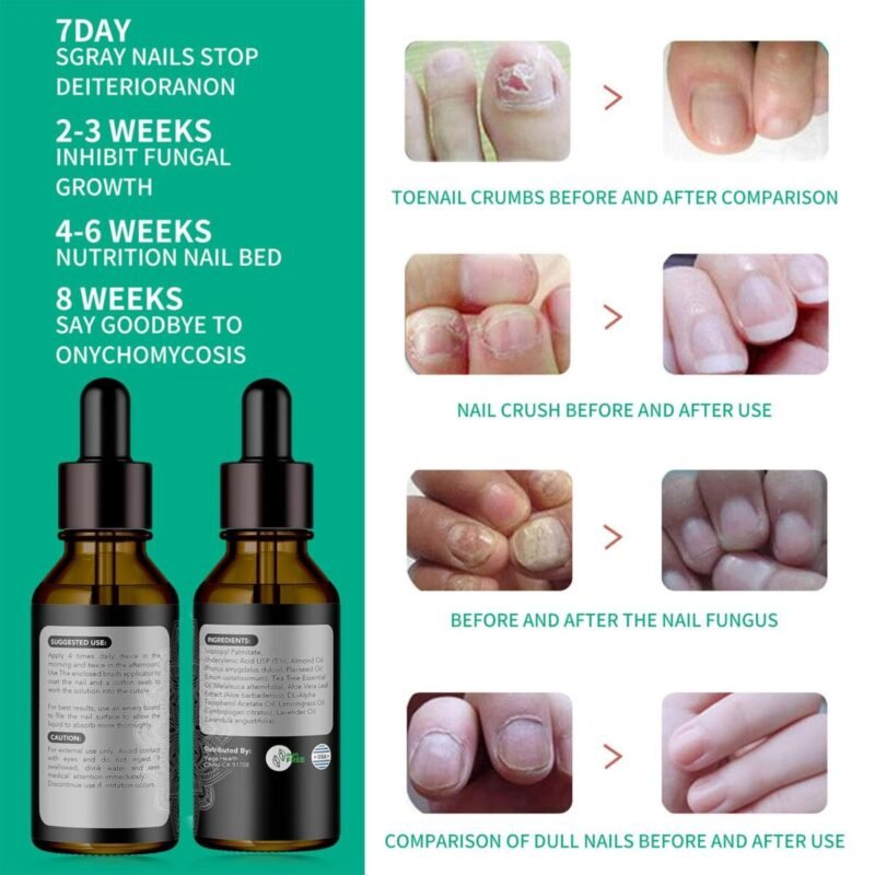 Nail Care, Nail Treatment, Metanail Toenail Treatment Serum