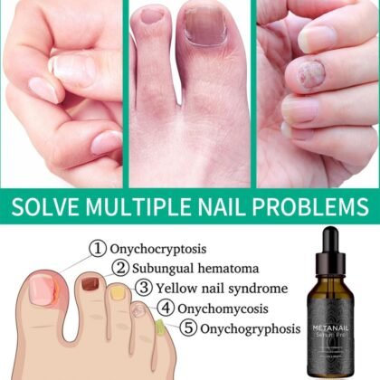 Nail Care, Nail Treatment, Metanail Toenail Treatment Serum